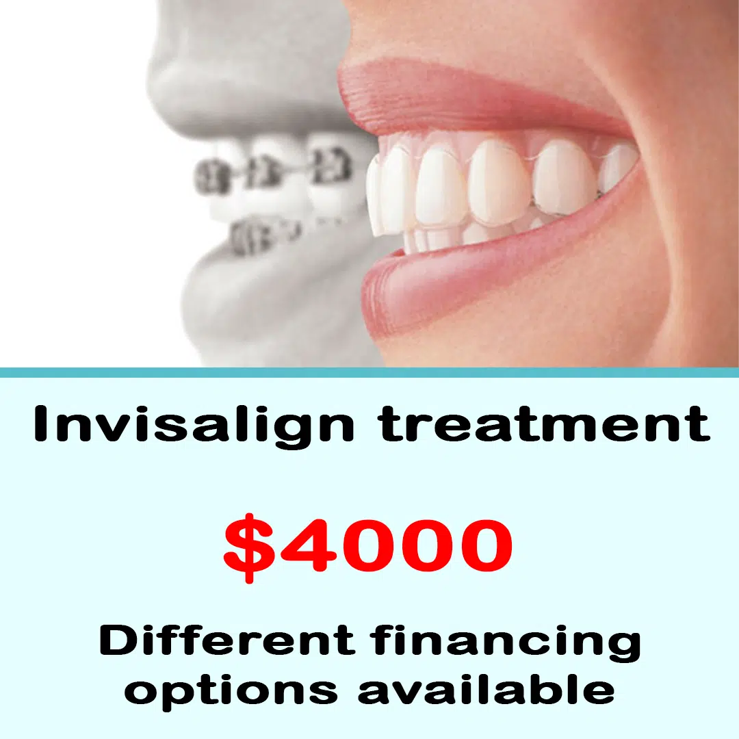 Invisalign treatment