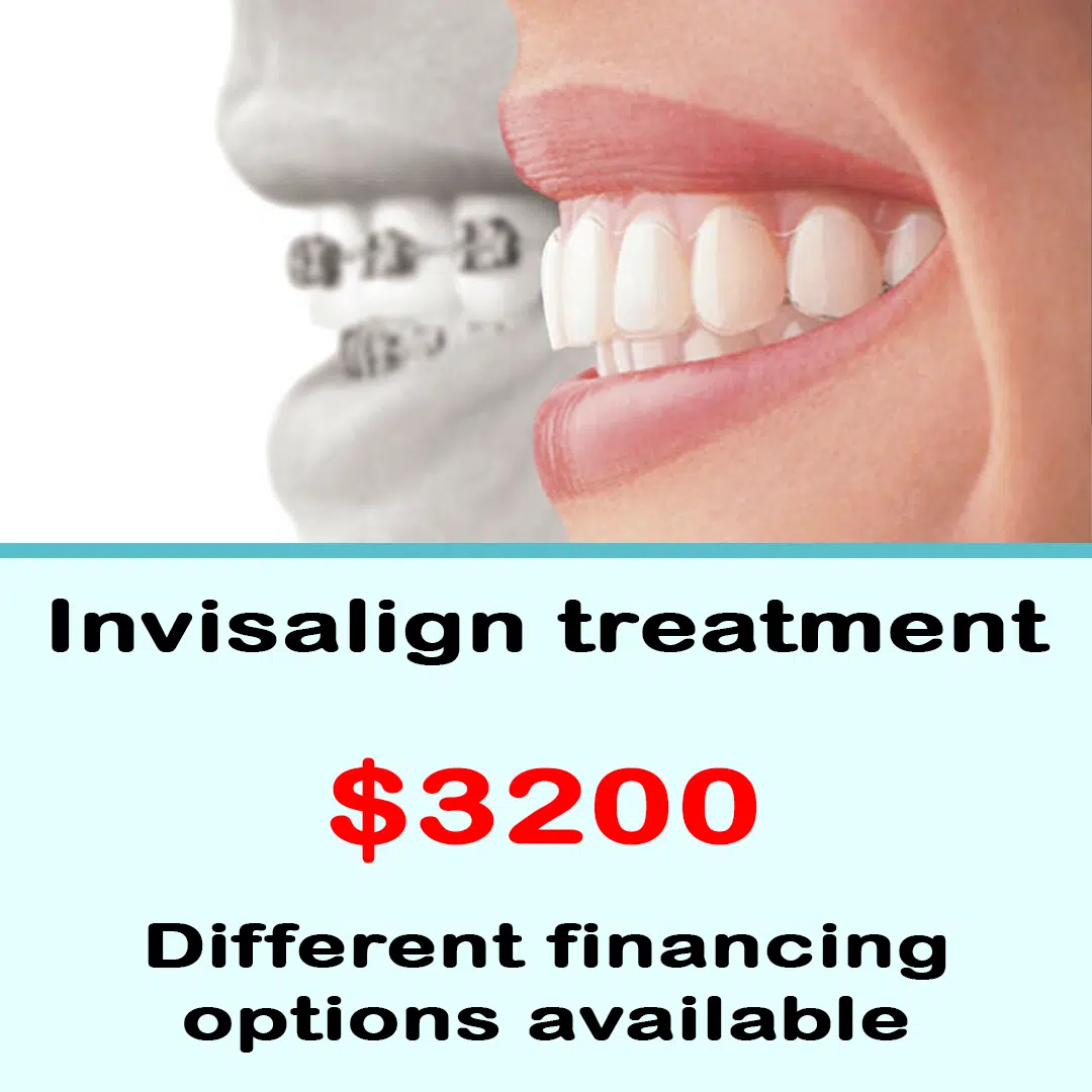 Invisalign treatment