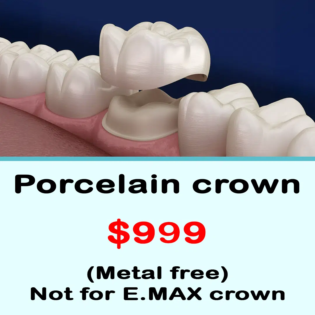 porcelain crown