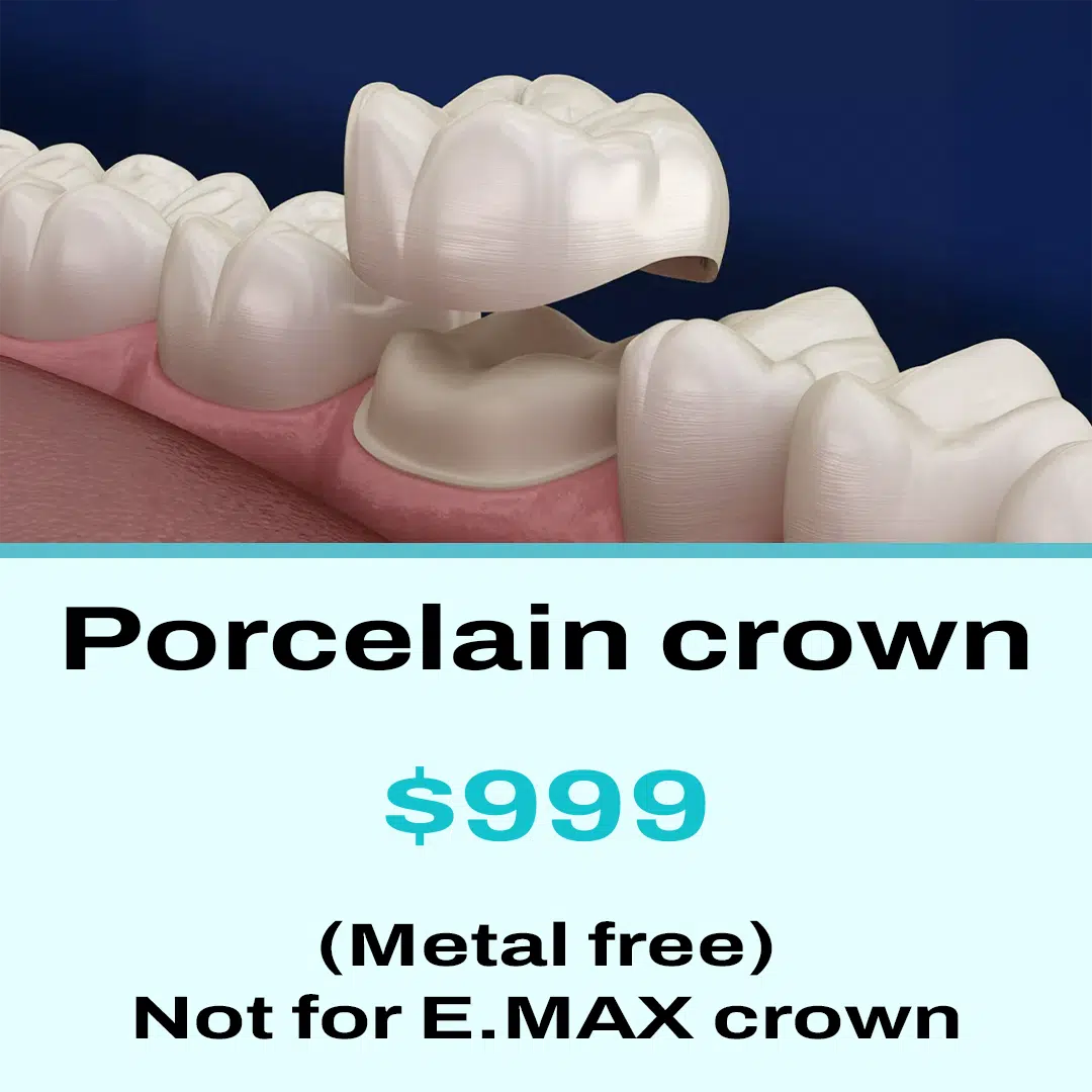 porcelain crown