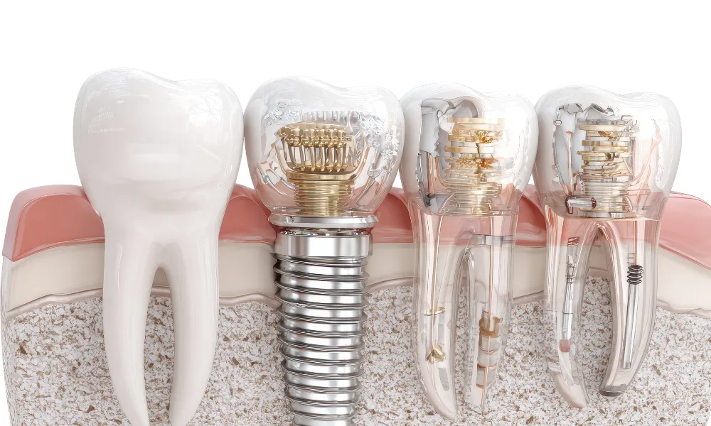 dental implants