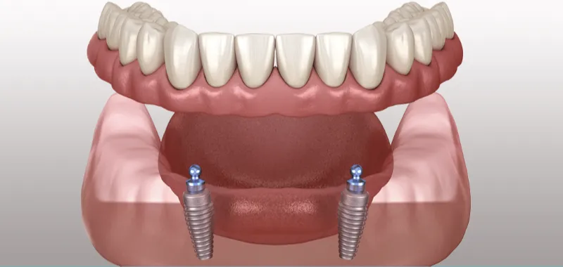 implan supported dentures 1