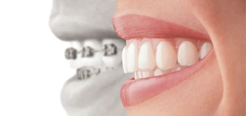 invisalign treatment 2