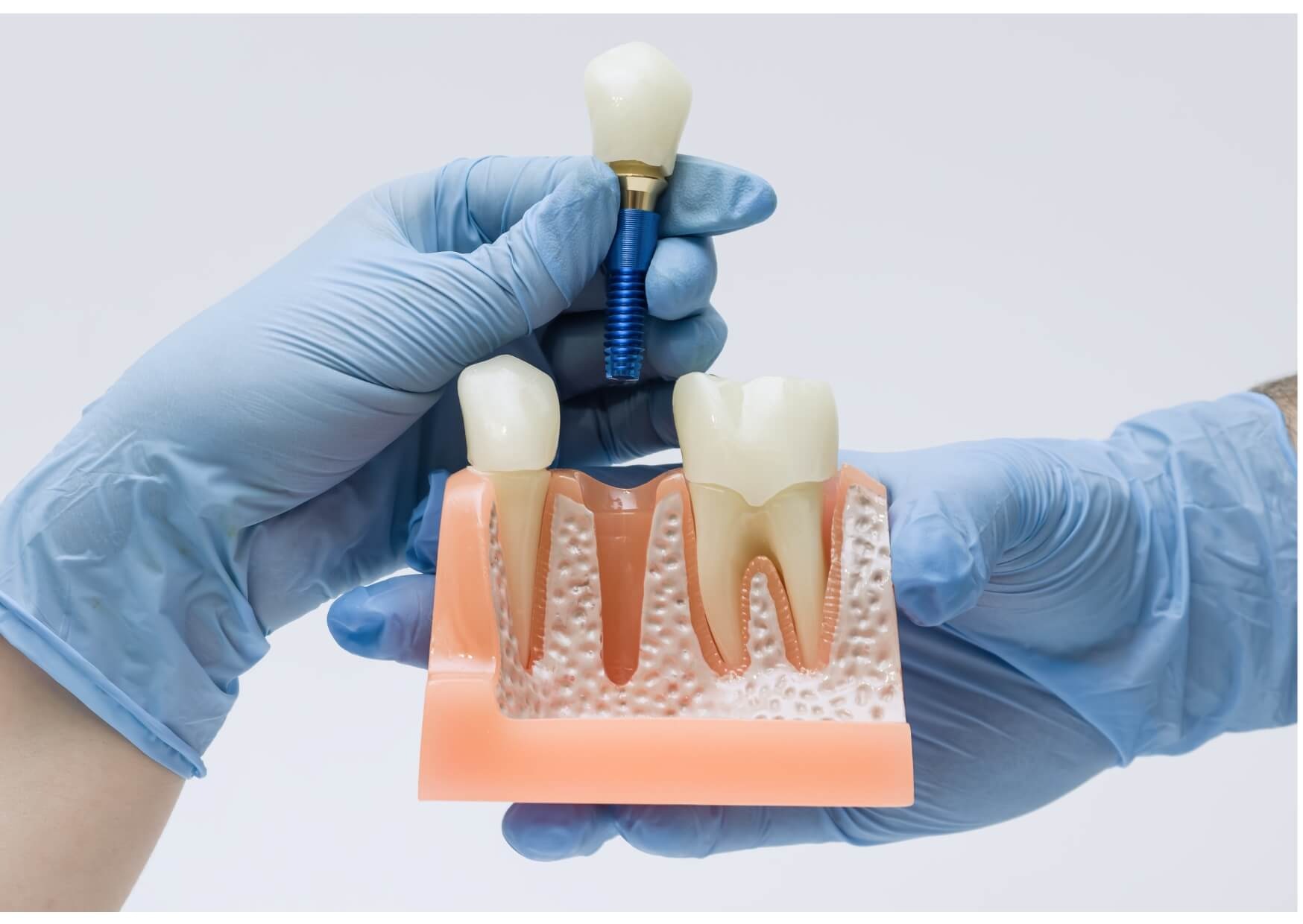 Dentist demonstrating how a dental implant crown is placed while explaining dental implants pros and cons