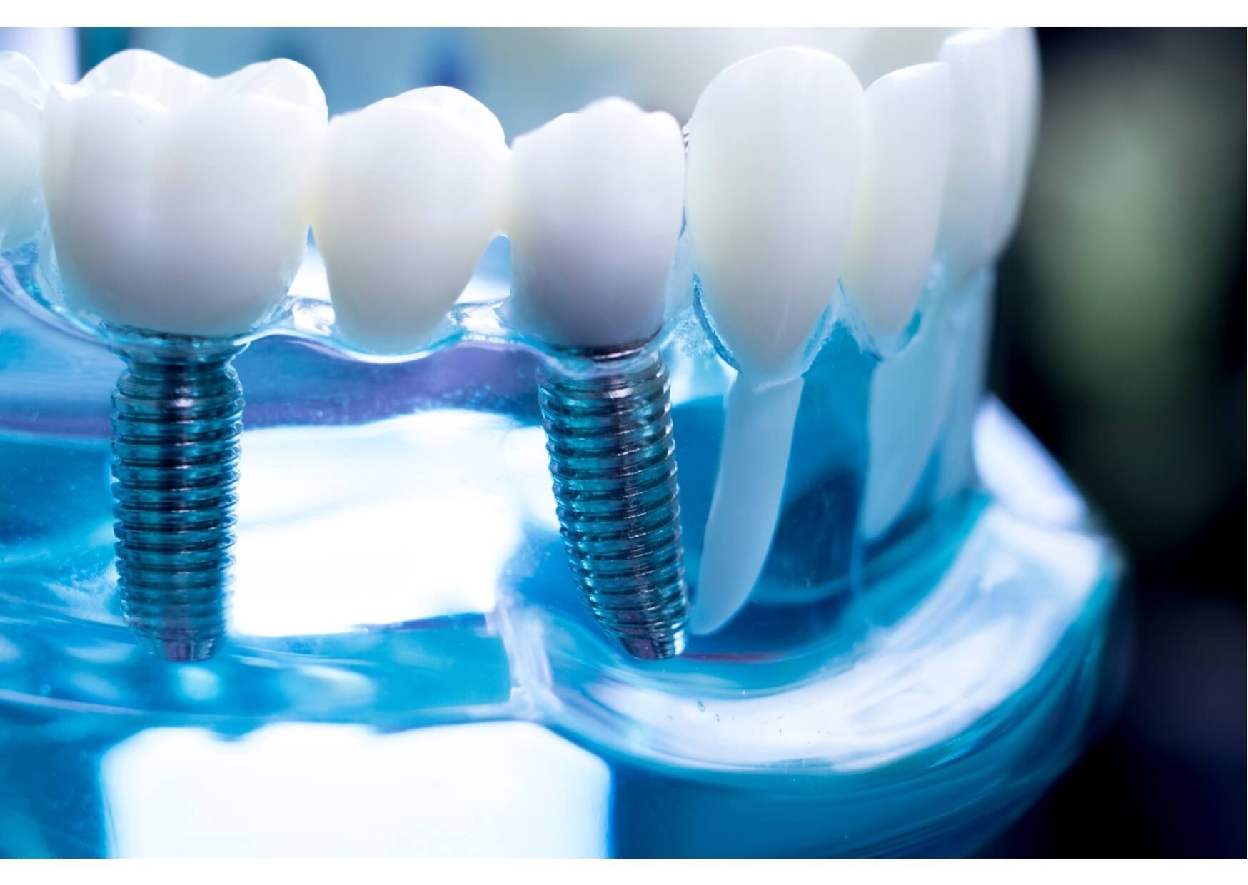 Close-up dental implant model showing implant-supported crowns used to explain the cost of dental implants