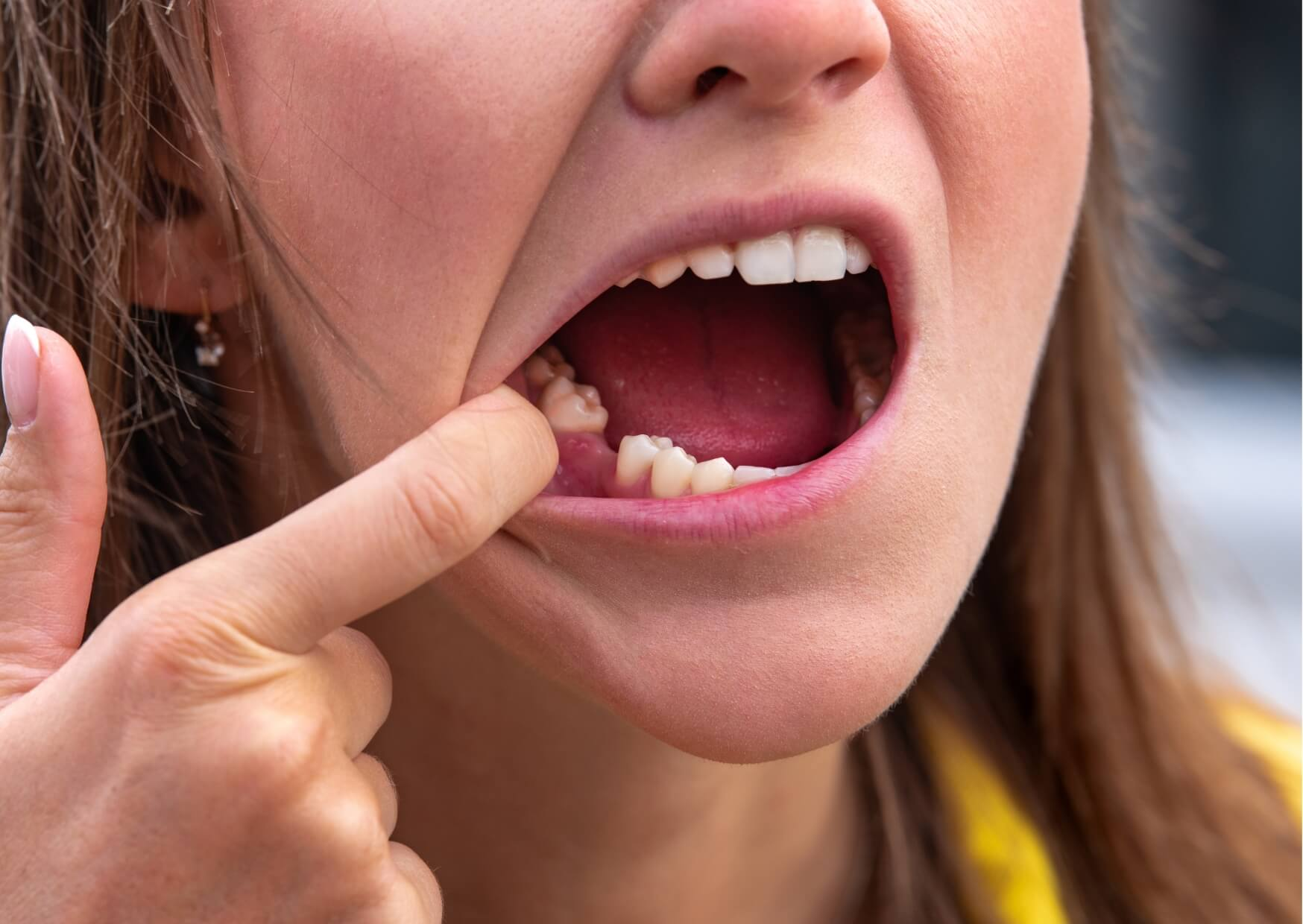 Close-up of a missing tooth space in the lower jaw, illustrating a common concern when asking how long it takes for a tooth to grow back.