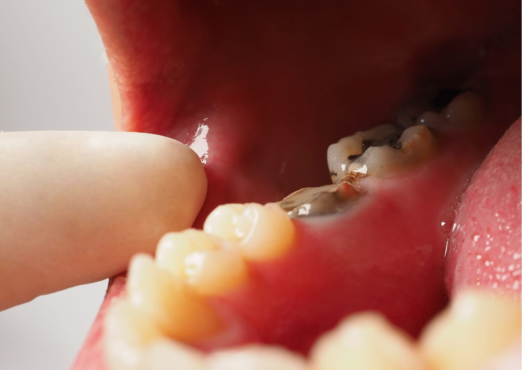 Close-up of a decayed molar showing dark cavities and damaged enamel, illustrating what tooth decay looks like in its advanced stages.